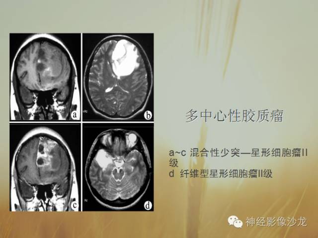 【病例】多灶性胶质瘤1例CT及MR影像表现