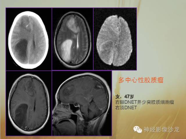 【病例】多灶性胶质瘤1例CT及MR影像表现
