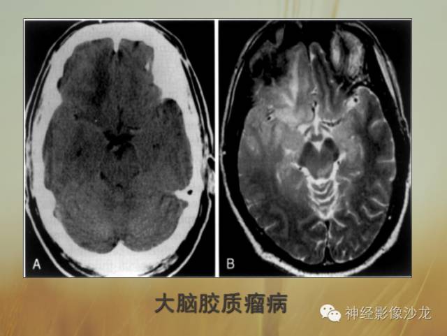 【病例】多灶性胶质瘤1例CT及MR影像表现