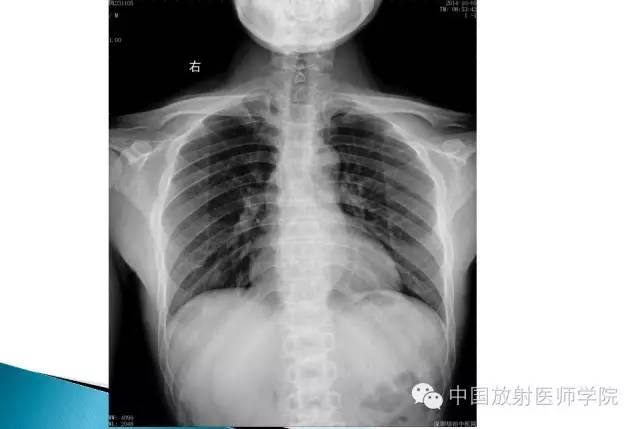 【病例】晚发型脊柱骨骺发育不良1例X线影像表现