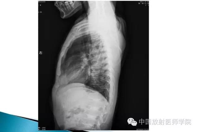 【病例】晚发型脊柱骨骺发育不良1例X线影像表现