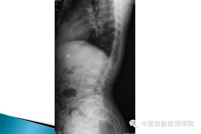 【病例】晚发型脊柱骨骺发育不良1例X线影像表现