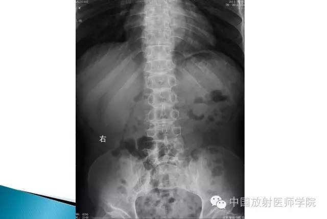 【病例】晚发型脊柱骨骺发育不良1例X线影像表现