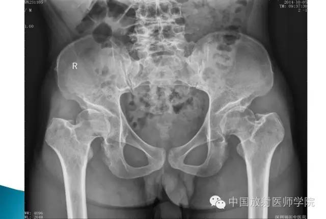 【病例】晚发型脊柱骨骺发育不良1例X线影像表现