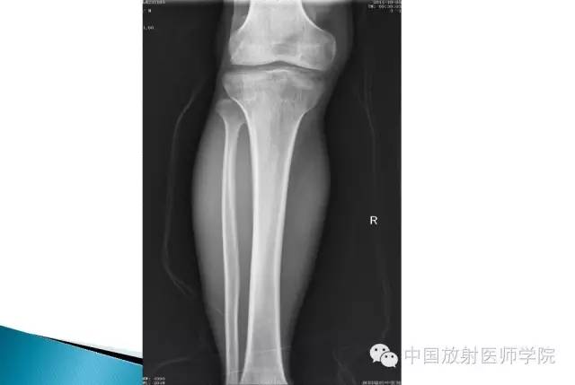 【病例】晚发型脊柱骨骺发育不良1例X线影像表现