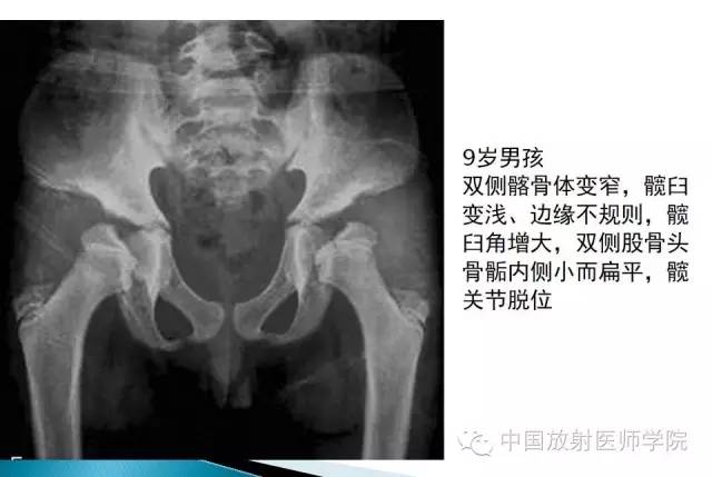 【病例】晚发型脊柱骨骺发育不良1例X线影像表现