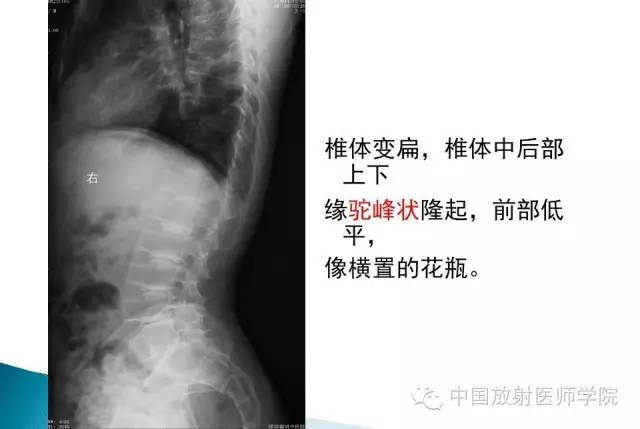 【病例】晚发型脊柱骨骺发育不良1例X线影像表现
