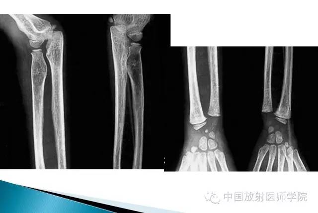 【病例】晚发型脊柱骨骺发育不良1例X线影像表现