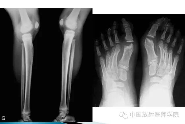 【病例】晚发型脊柱骨骺发育不良1例X线影像表现