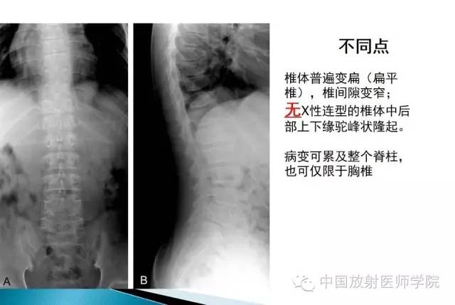 【病例】晚发型脊柱骨骺发育不良1例X线影像表现