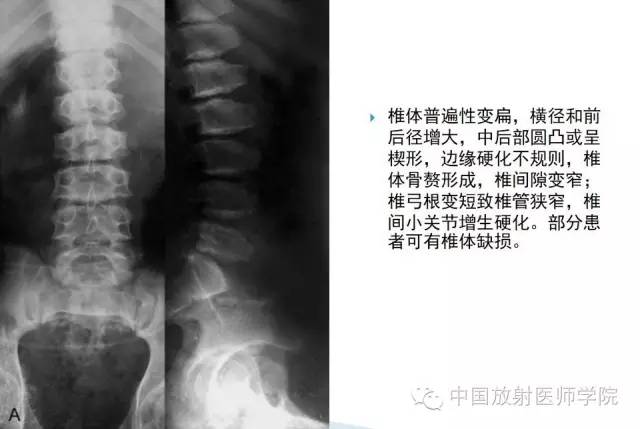 【病例】晚发型脊柱骨骺发育不良1例X线影像表现