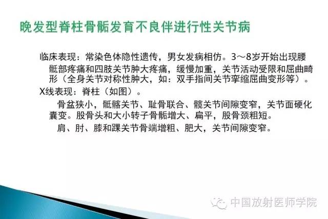 【病例】晚发型脊柱骨骺发育不良1例X线影像表现