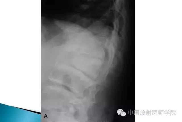 【病例】晚发型脊柱骨骺发育不良1例X线影像表现