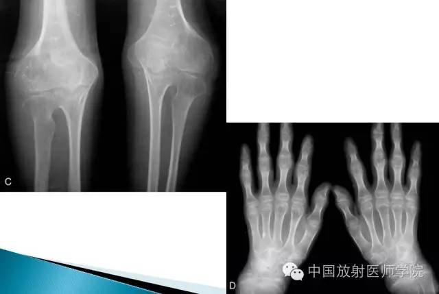 【病例】晚发型脊柱骨骺发育不良1例X线影像表现