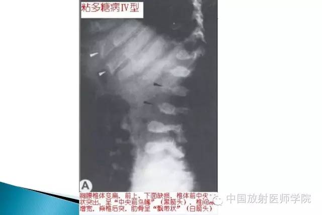 【病例】晚发型脊柱骨骺发育不良1例X线影像表现