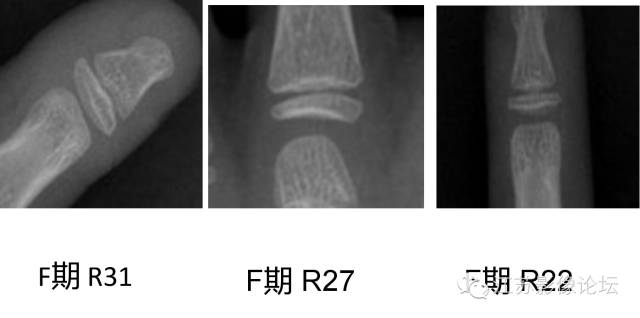 骨龄概况及其测评方法