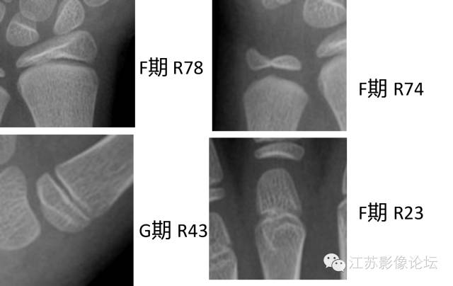 骨龄概况及其测评方法