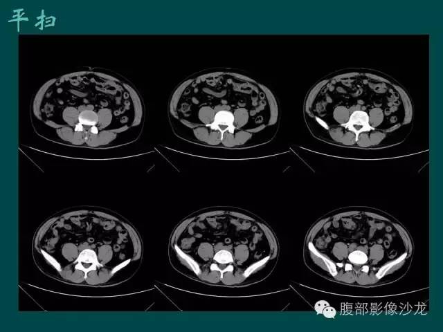 【病例】小肠胃肠道间质瘤1例CT影像表现