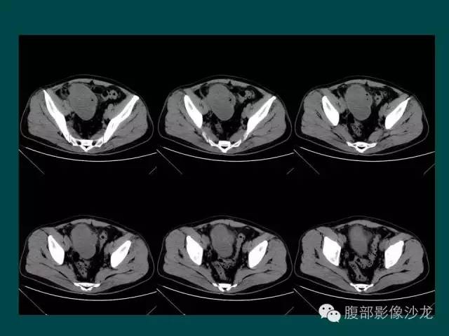 【病例】小肠胃肠道间质瘤1例CT影像表现