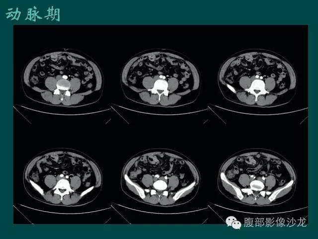 【病例】小肠胃肠道间质瘤1例CT影像表现