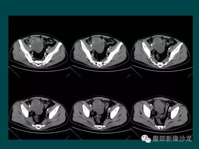 【病例】小肠胃肠道间质瘤1例CT影像表现