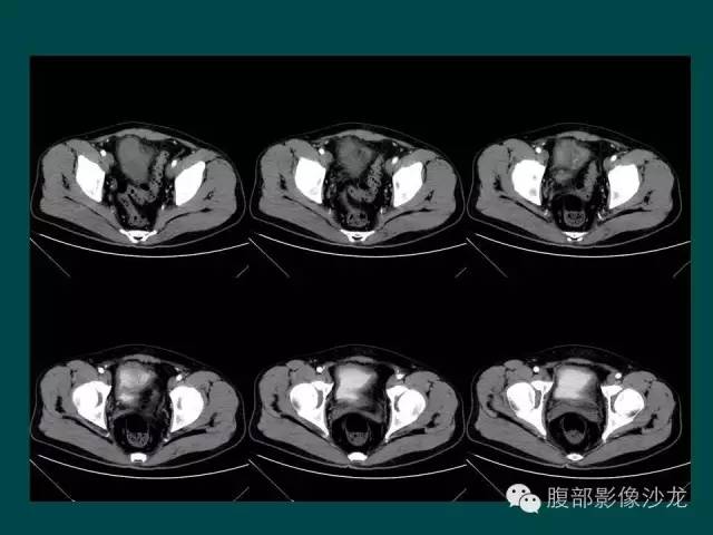 【病例】小肠胃肠道间质瘤1例CT影像表现