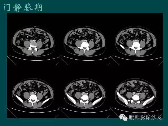 【病例】小肠胃肠道间质瘤1例CT影像表现
