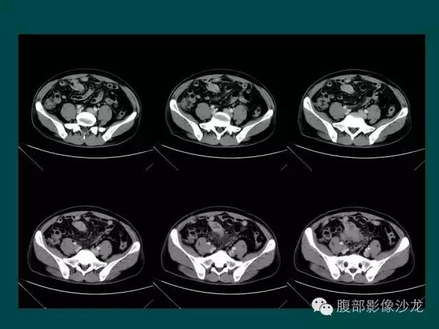 【病例】小肠胃肠道间质瘤1例CT影像表现