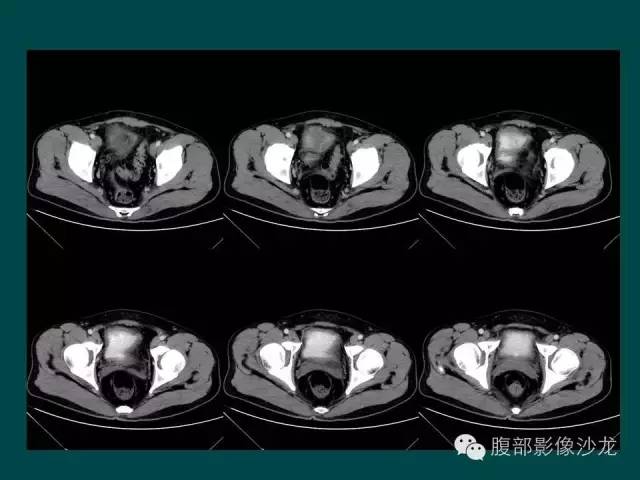 【病例】小肠胃肠道间质瘤1例CT影像表现