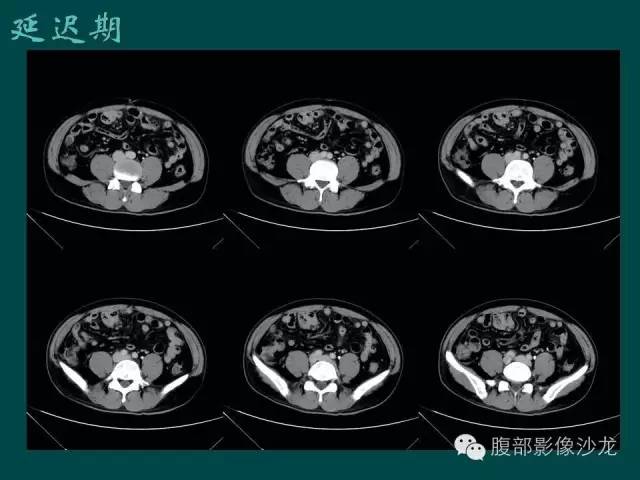 【病例】小肠胃肠道间质瘤1例CT影像表现