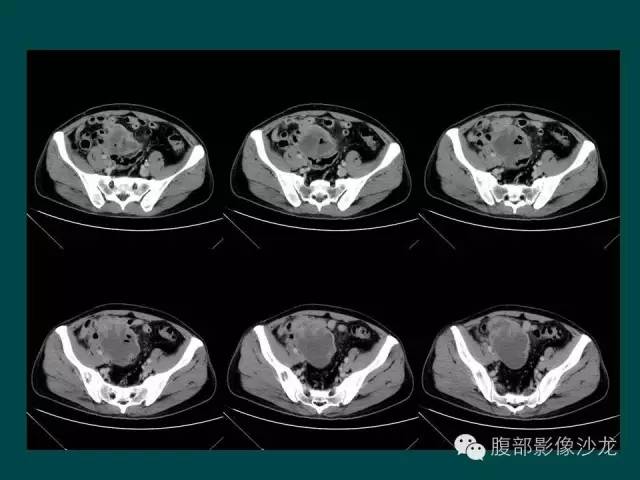【病例】小肠胃肠道间质瘤1例CT影像表现