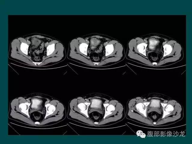 【病例】小肠胃肠道间质瘤1例CT影像表现
