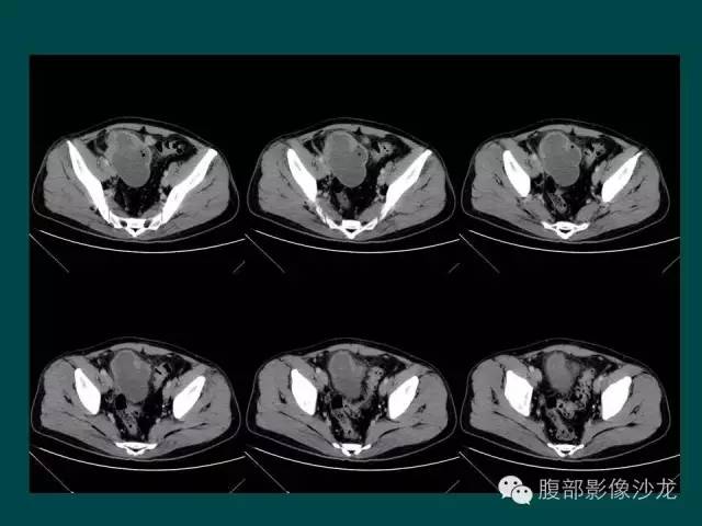 【病例】小肠胃肠道间质瘤1例CT影像表现