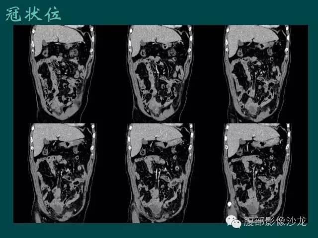 【病例】小肠胃肠道间质瘤1例CT影像表现