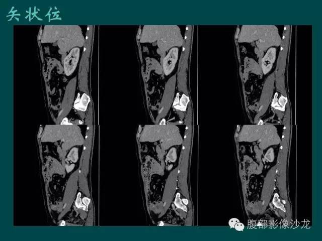 【病例】小肠胃肠道间质瘤1例CT影像表现