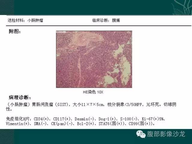 【病例】小肠胃肠道间质瘤1例CT影像表现