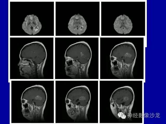 【病例】间变性室管膜瘤1例CT影像表现