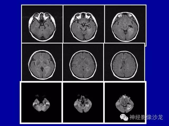 【病例】间变性室管膜瘤1例CT影像表现
