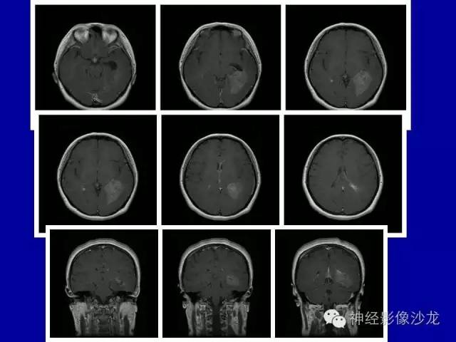 【病例】间变性室管膜瘤1例CT影像表现