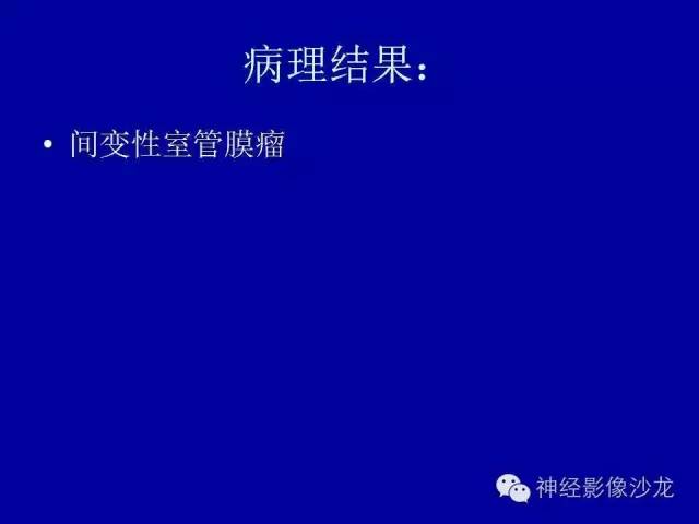 【病例】间变性室管膜瘤1例CT影像表现