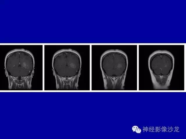 【病例】间变性室管膜瘤1例CT影像表现