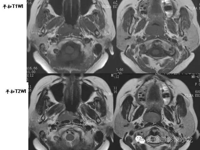 【病例】鼻咽部淋巴瘤1例MR影像表现 【病例】鼻咽部淋巴瘤1例MR影像表现