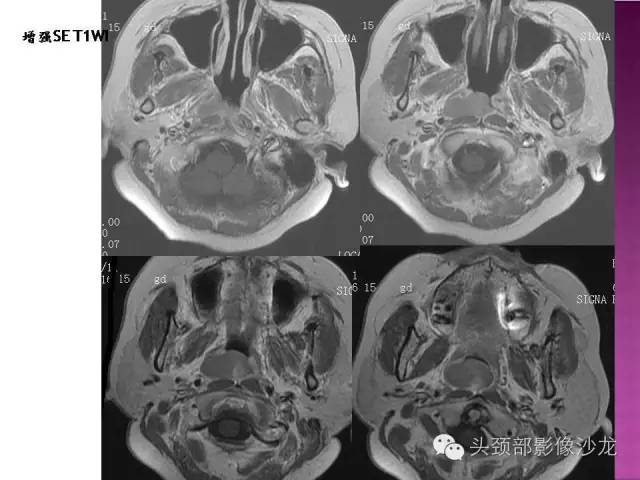 【病例】鼻咽部淋巴瘤1例MR影像表现