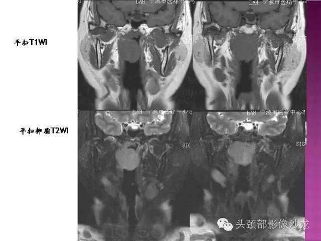【病例】鼻咽部淋巴瘤1例MR影像表现