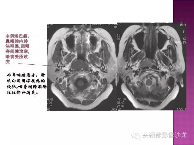 【病例】鼻咽部淋巴瘤1例MR影像表现 【病例】鼻咽部淋巴瘤1例MR影像表现