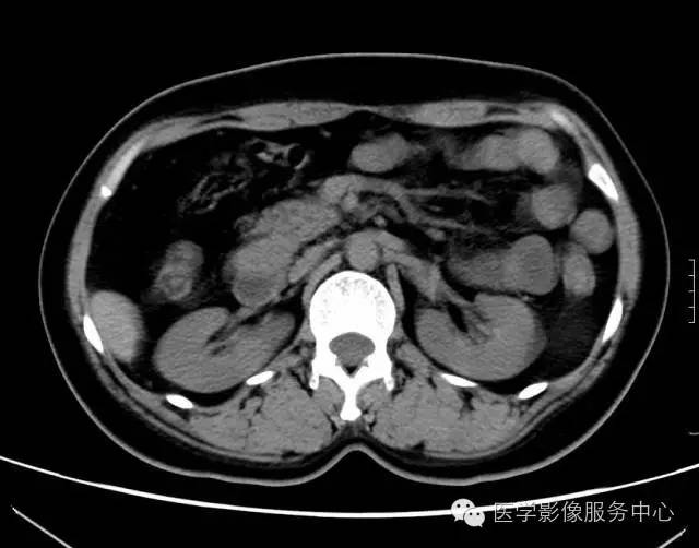 【误诊病例】肠套叠？十二指肠憩室炎伴憩室内翻入肠腔1例CT影像表现