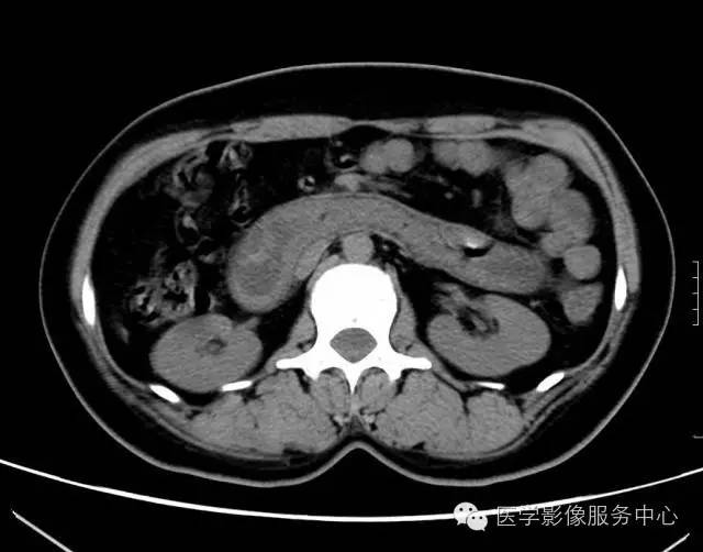 【误诊病例】肠套叠?十二指肠憩室炎伴憩室内翻入肠腔1例CT影像表现 【误诊病例】肠套叠?十二指肠憩室炎伴憩室内翻入肠腔1例CT影像表现