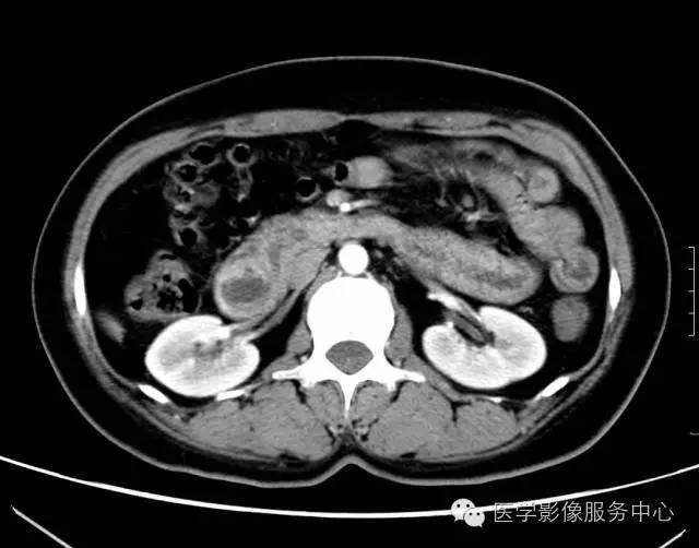 【误诊病例】肠套叠?十二指肠憩室炎伴憩室内翻入肠腔1例CT影像表现 【误诊病例】肠套叠?十二指肠憩室炎伴憩室内翻入肠腔1例CT影像表现