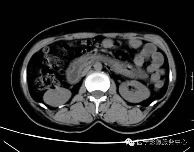 【误诊病例】肠套叠?十二指肠憩室炎伴憩室内翻入肠腔1例CT影像表现 【误诊病例】肠套叠?十二指肠憩室炎伴憩室内翻入肠腔1例CT影像表现