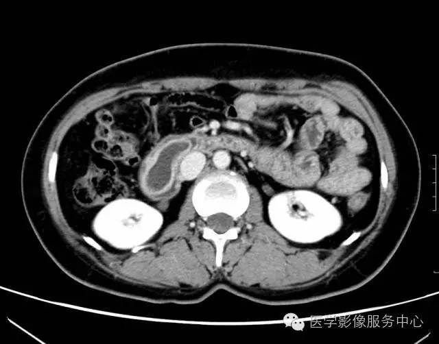 【误诊病例】肠套叠?十二指肠憩室炎伴憩室内翻入肠腔1例CT影像表现 【误诊病例】肠套叠?十二指肠憩室炎伴憩室内翻入肠腔1例CT影像表现